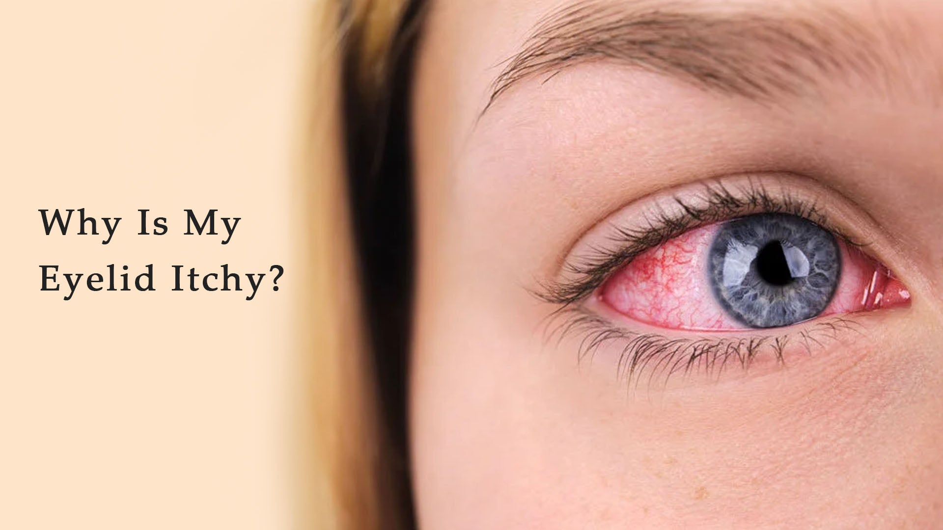 Why Is My Eyelid Itchy?