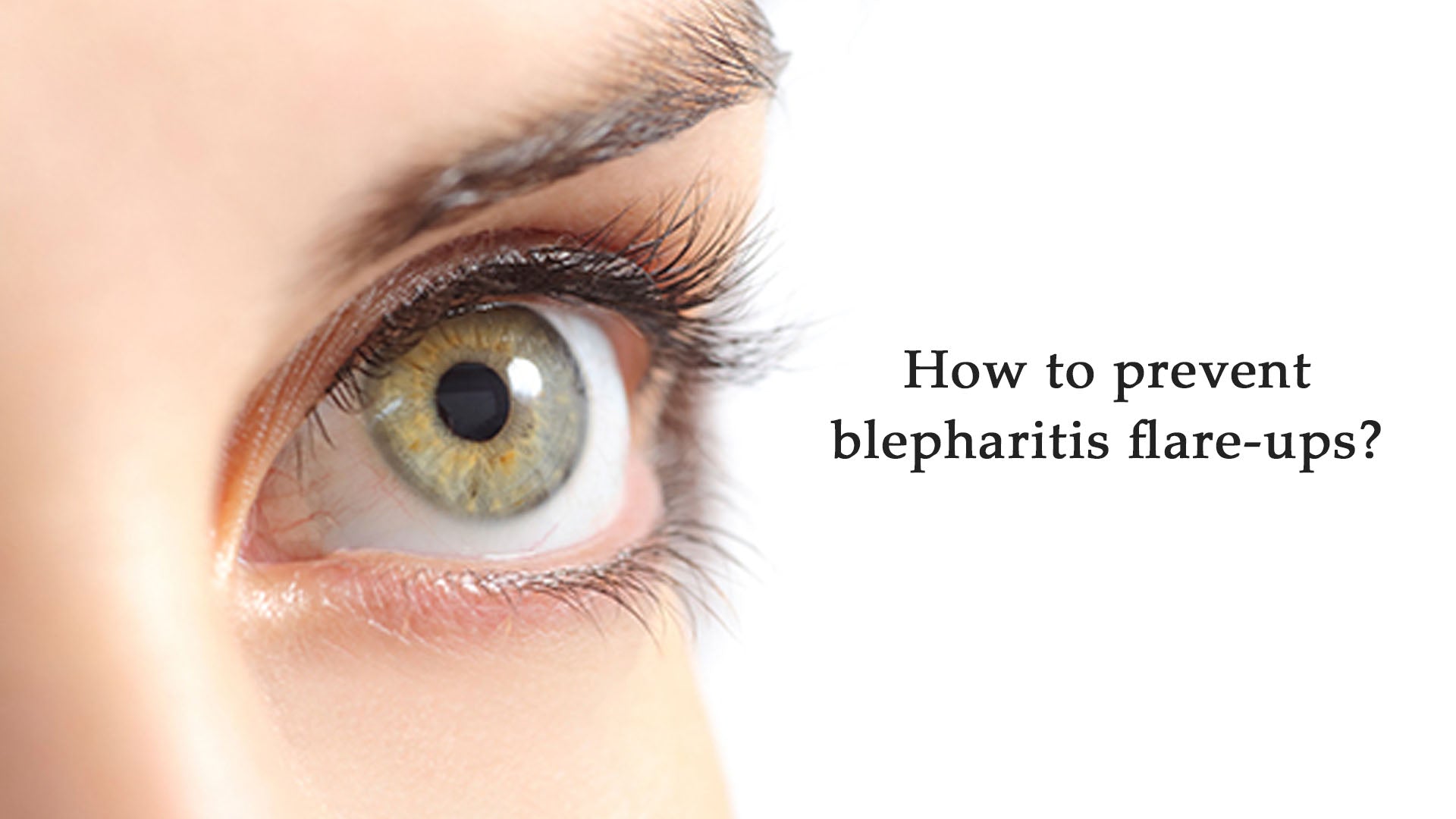 How to prevent blepharitis flare-ups?