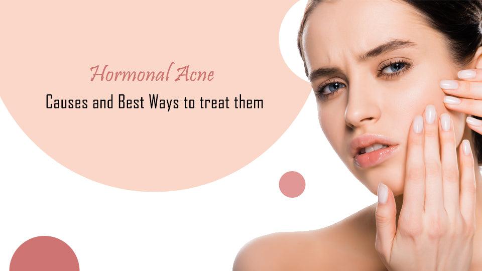Hormonal Acne: Causes and Best Ways to treat them
