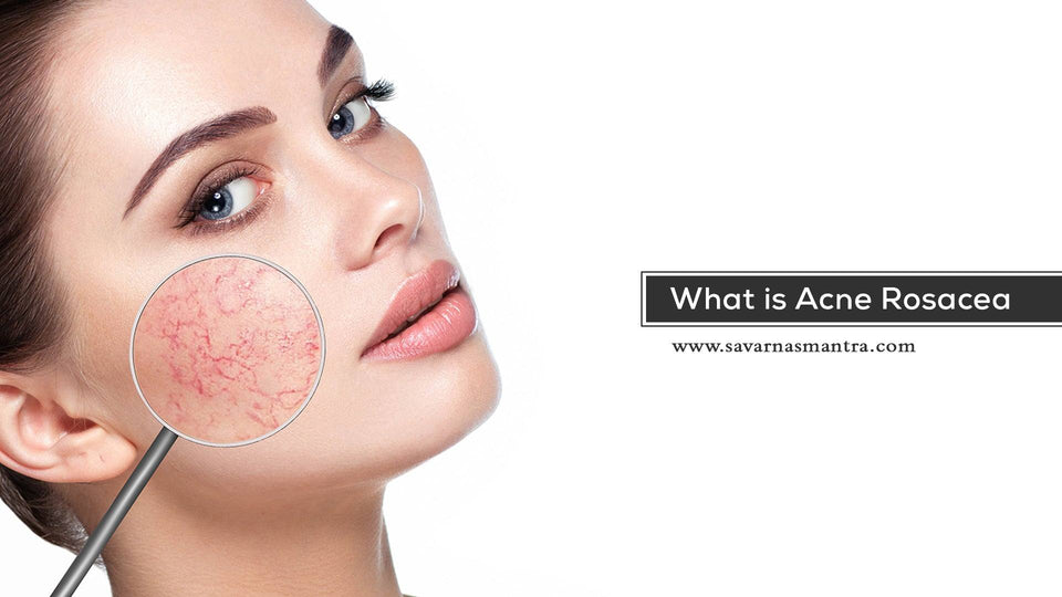 What is Acne Rosacea? How to cure it? - SavarnasMantra