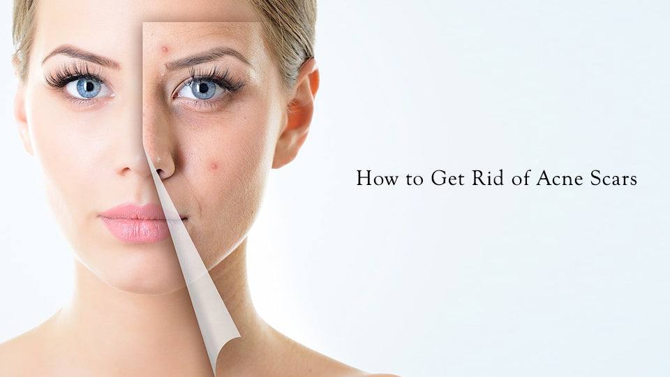 How to get rid of acne scars? - SavarnasMantra
