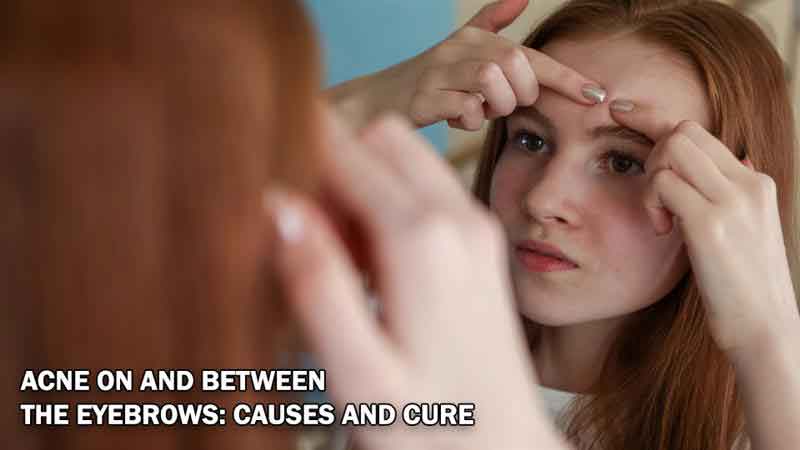 Acne On and Between the Eyebrows: Causes and Cure