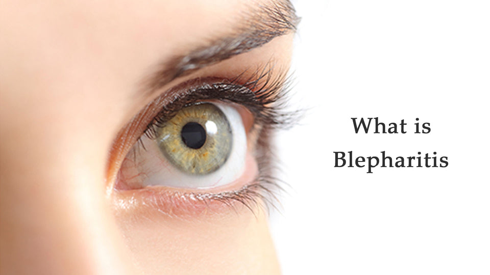 What is Blepharitis?