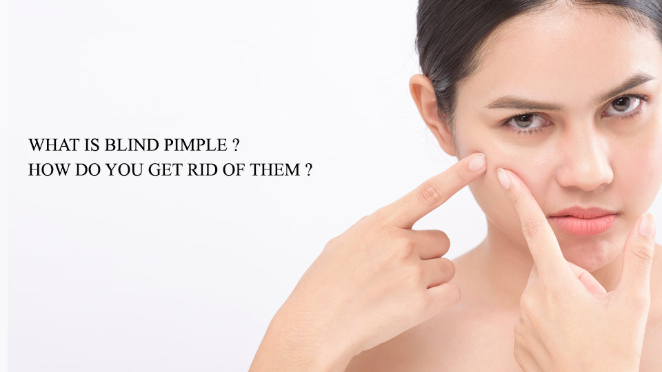 What Is Blind Pimple? How Do You Get Rid of Them?