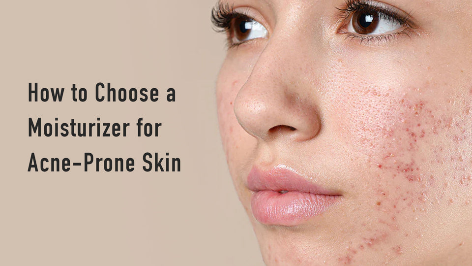 How to Choose a Moisturizer for Acne-Prone Skin