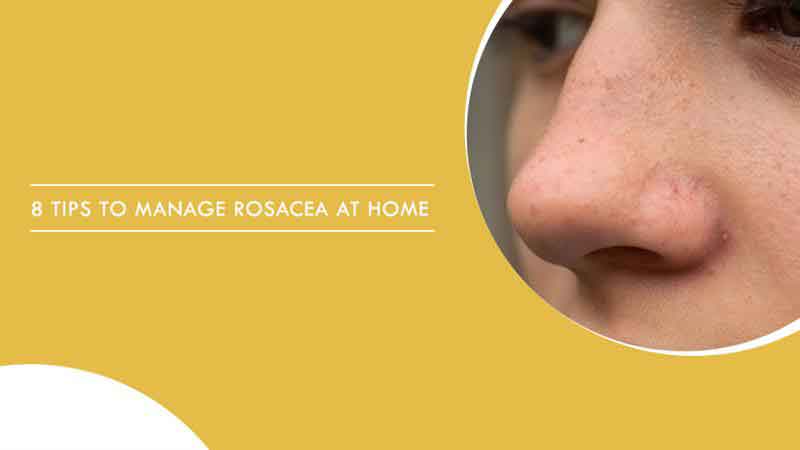 8 Tips To Manage Rosacea at Home