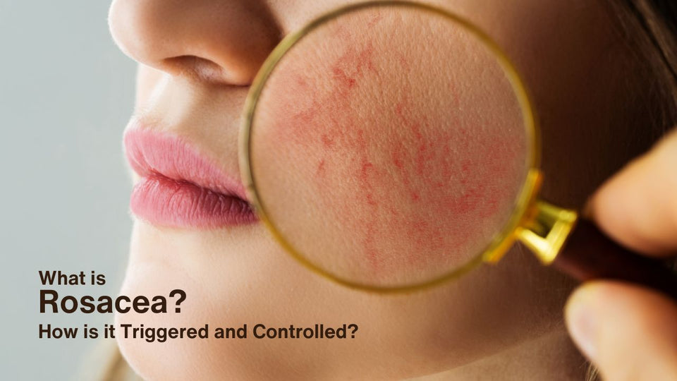 What is Rosacea? How is it Triggered and Controlled?