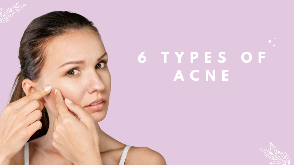 6 Types of Acne