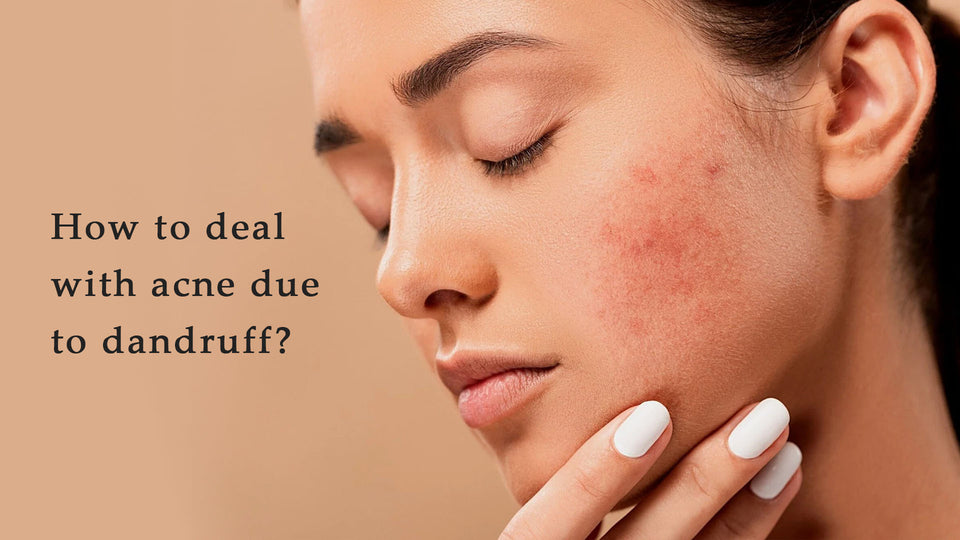 How to deal with acne due to dandruff?