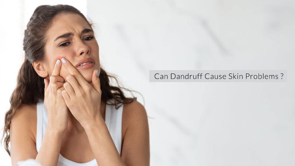 Can Dandruff Cause Skin Problems? - SavarnasMantra