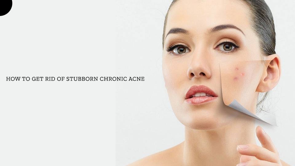 How to get rid of stubborn chronic acne - SavarnasMantra