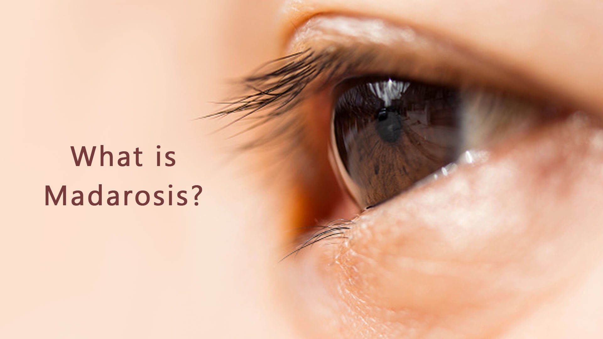 What Is Madarosis SavarnasMantra what-is-madarosis-savarnasmantra