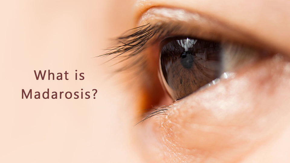What is Madarosis?